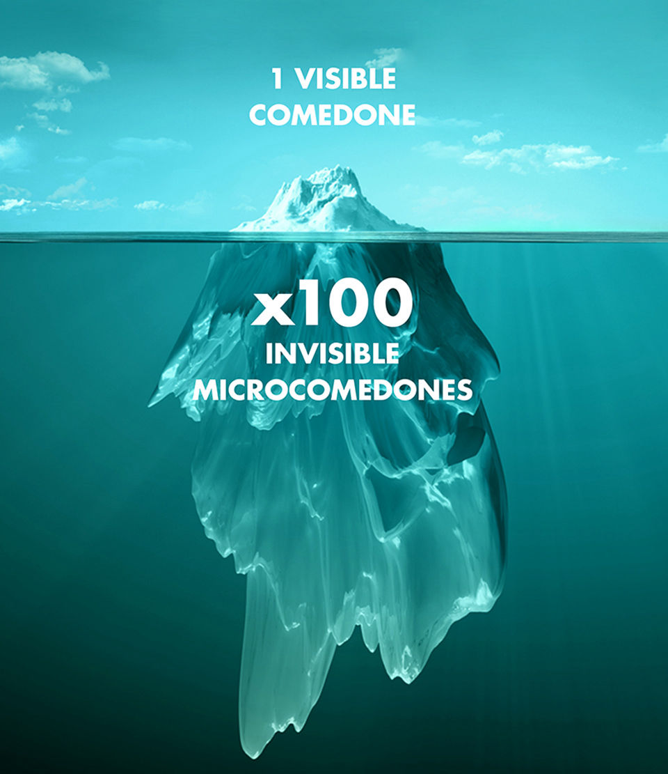 1 Visible Comedone - x100 invisible microcomedoned